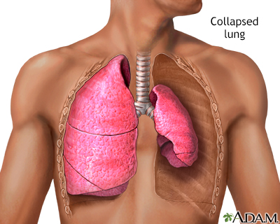 Collapsed lung, pneumothorax