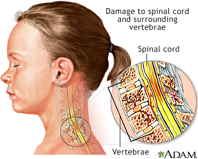 Spinal cord injury