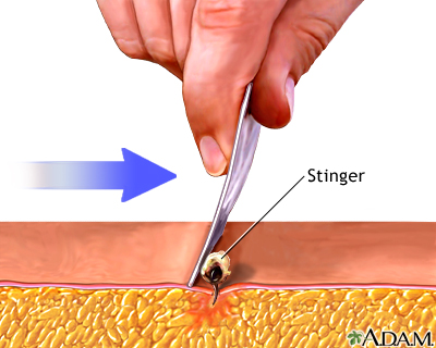 Stinger removal