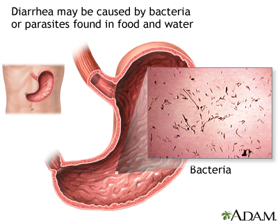 Diarrhea