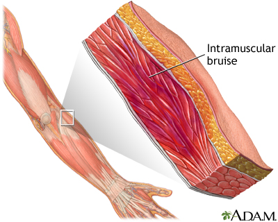 Muscle bruise