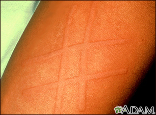 Dermatographism on the arm