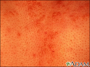 Sarcoid - close-up of the skin lesions