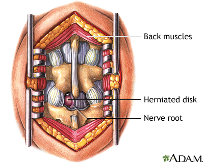 Microdiskectomy - Indications