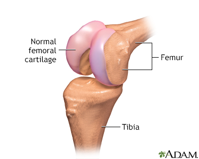 Partial knee replacement - series