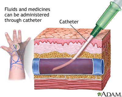 Peripheral intravenous line