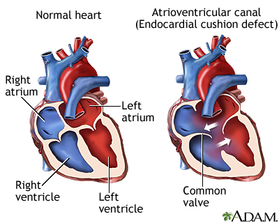 Atrioventricular canal (endocardial cushion defect)