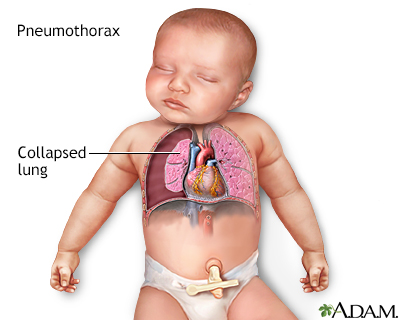 Pneumothorax