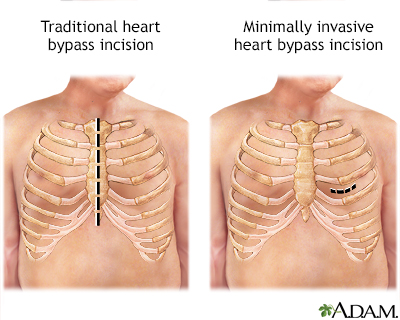 Heart bypass surgery incision