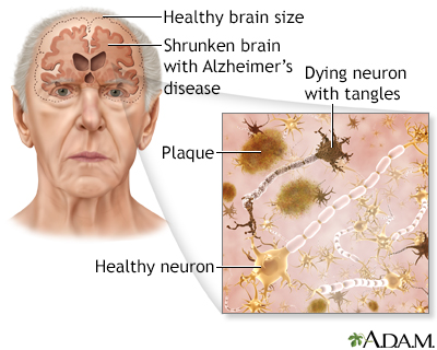 Alzheimer disease