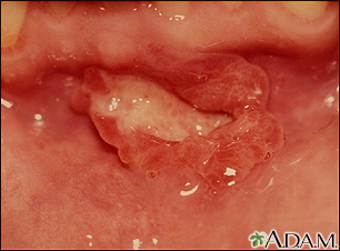 Canker sore (aphthous ulcer)