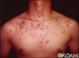 Acne - cystic on the chest