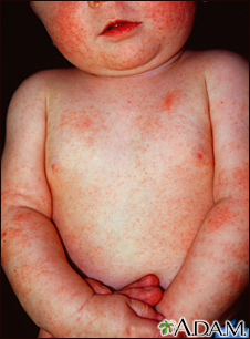 Dermatitis - atopic in an infant