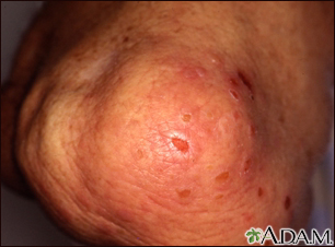 Dermatitis - herpetiformis on the knee