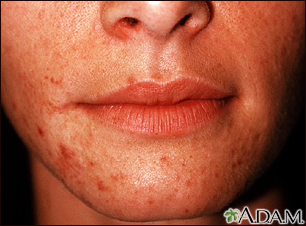 Perioral dermatitis