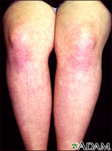 Dermatomyositis on the legs