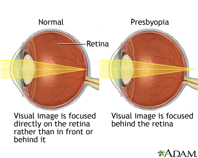 Presbyopia