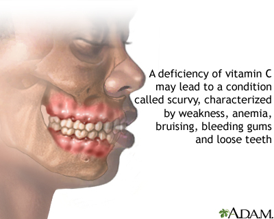 Vitamin C deficit