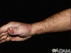 Sporotrichosis on the hand and arm