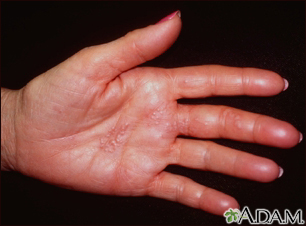 Herpes zoster (shingles) on the hand