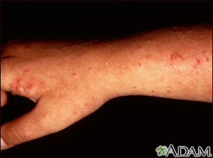 Polymorphic light eruption on the arm