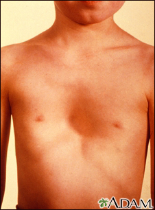 Pectus excavatum