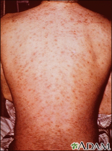 Drug rash on the back