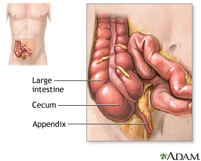 Appendectomy - series