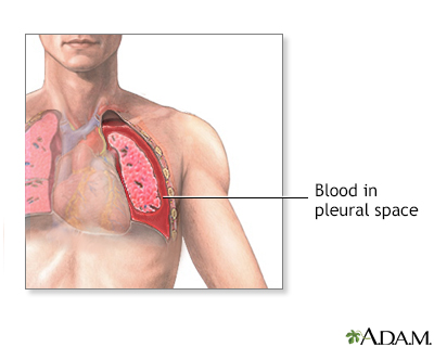 Hemothorax