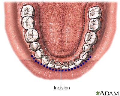 Incision