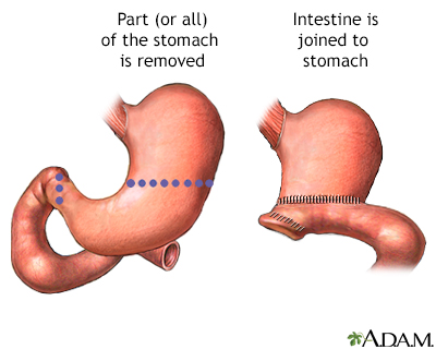 Gastrectomy