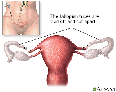 Tubal ligation