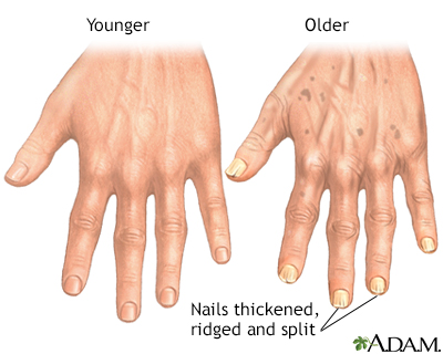 Aging changes in nails