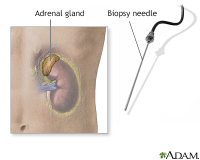 Adrenal gland biopsy