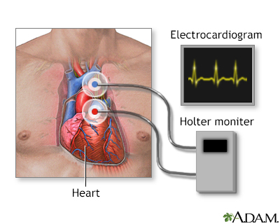 Holter heart monitor