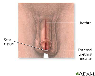 Meatal stenosis