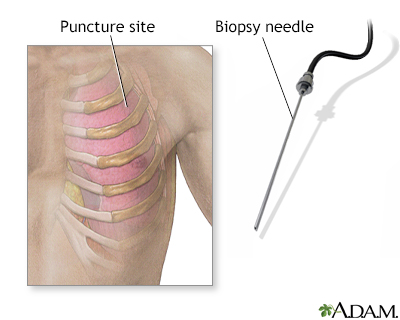 Pleural biopsy