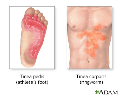 Tinea (ringworm)