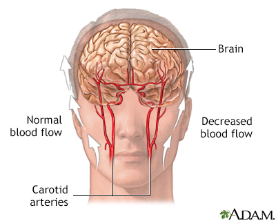 Transient Ischemic attack (TIA)