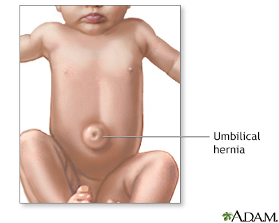 Umbilical hernia