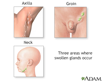 Swollen glands