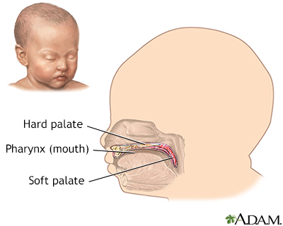 Infant hard and soft palates