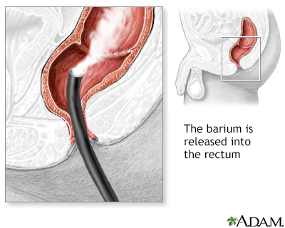 Barium enema