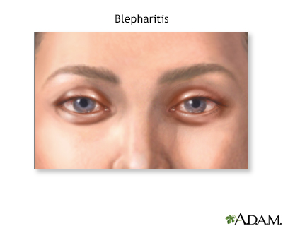 Blepharitis