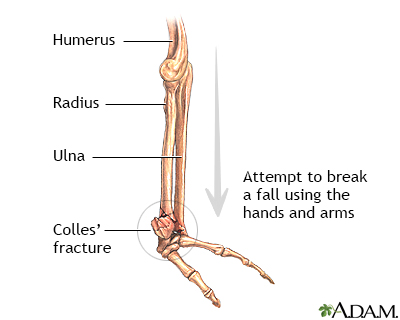 Colles fracture