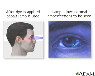 Fluorescent eye test