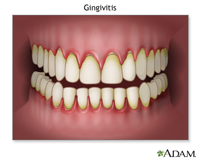 Gingivitis