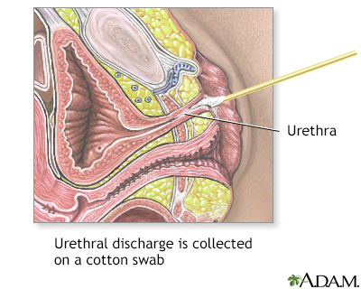 Gram stain of urethral discharge