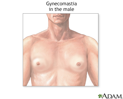 Gynecomastia