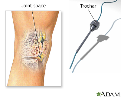 Synovial biopsy